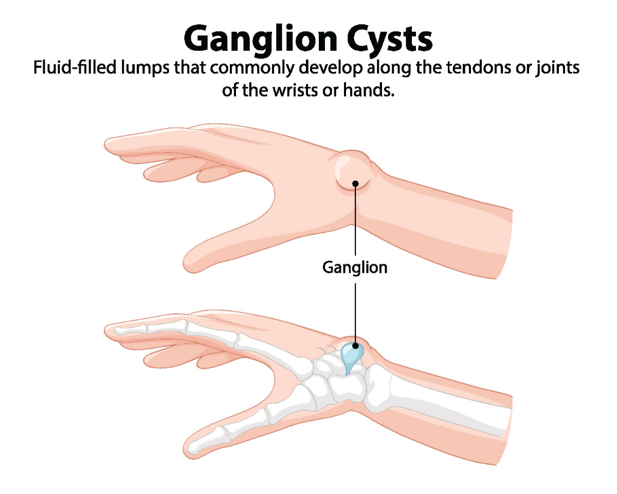 ganglion cyst anatomy