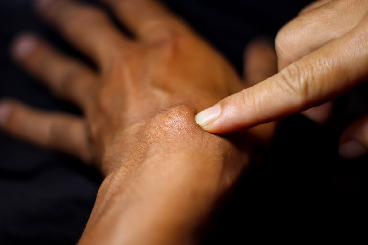 ganglion cyst on wrist