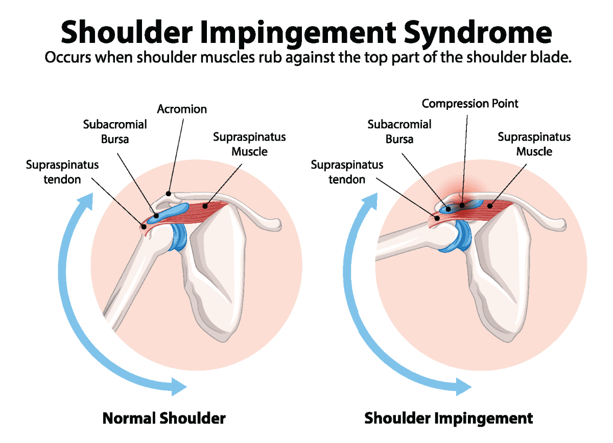 Shoulder Impingement Syndrome